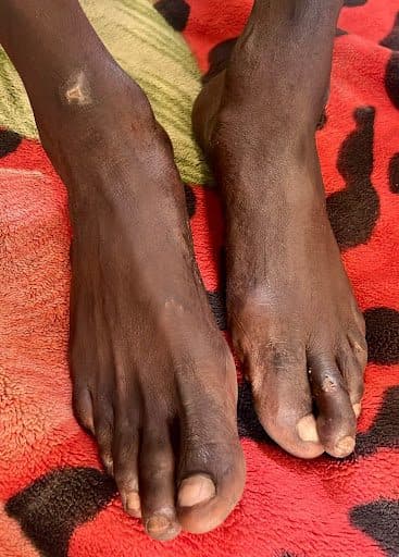 Two dark-skinned feet resting on a red and black patterned blanket, with a small scar visible on one ankle.