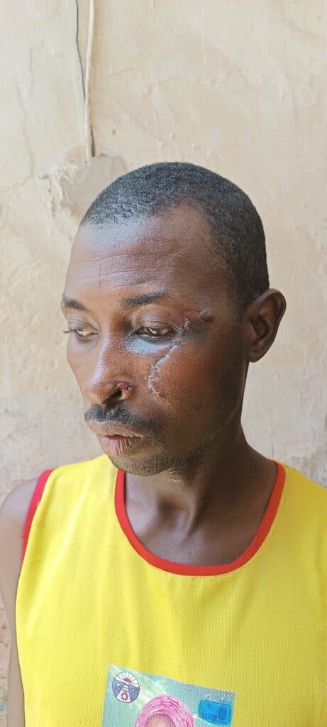 Man with facial scars standing against a cream-colored wall.