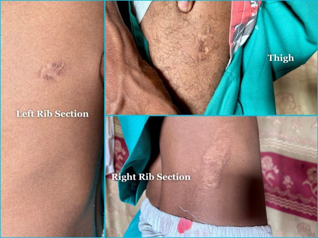 Close-up of scarred skin in three areas: left rib, thigh, and right rib sections, each labeled with text.